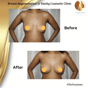 VCC Breast Lift Before After