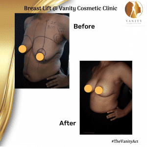 VCC Breast Lift Before After