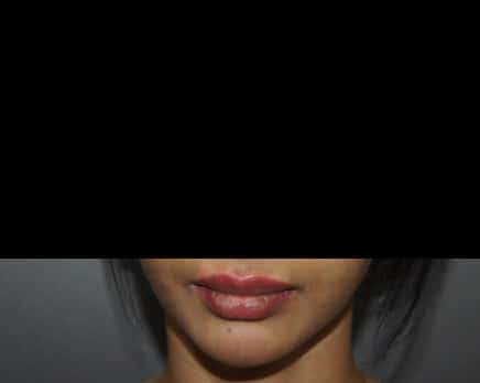 Chin Fillers