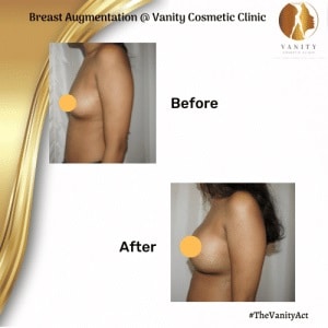 Breast-Augmentation-Surgery-Before-After-set-three