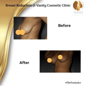 Breast-Reduction-Before-After-Set-Two