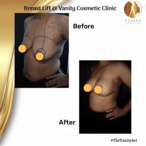 breast-lift-surgery-set-two