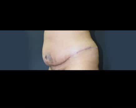 tummy tuck after set two