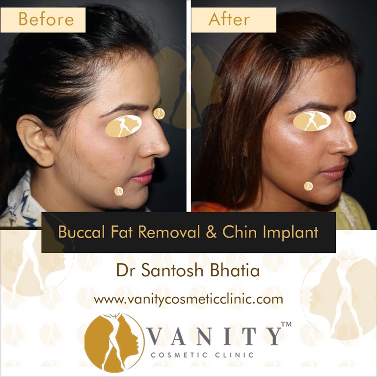 Buccal-Fat-Removal-and-Chin-Implant-45-deg-right-side-view