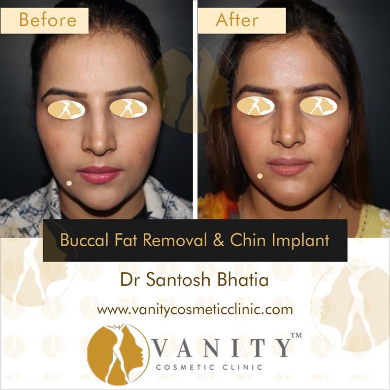 Buccal-Fat-Removal-and-Chin-Implant-front-view