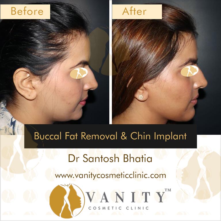 Buccal-Fat-Removal-and-Chin-Implant-right-side-view