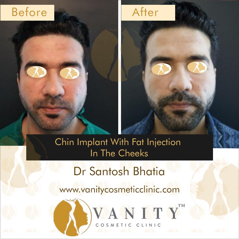 Chin-Implant-with-fat-injection-in-the-cheeks-front-view