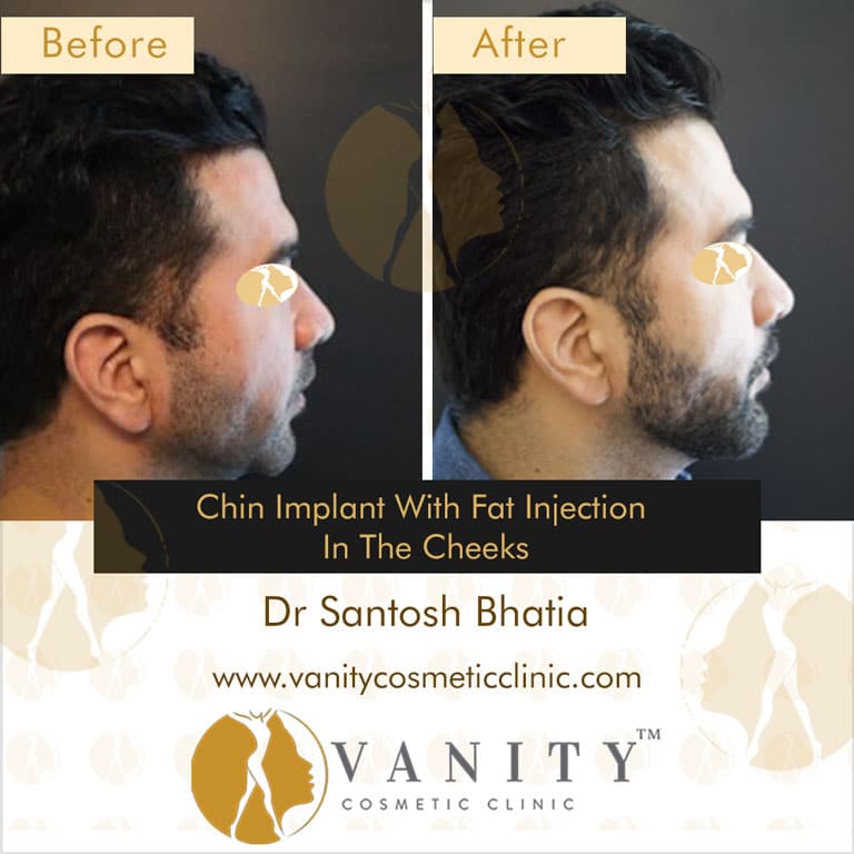 Chin-Implant-with-fat-injection-in-the-cheeks-right-side-view