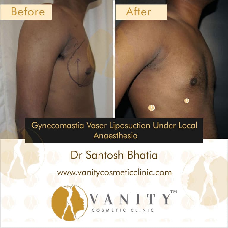 Gynecomastia-Vaser-Liposuction-under-local-anaesthesia-right-side-view-case-5