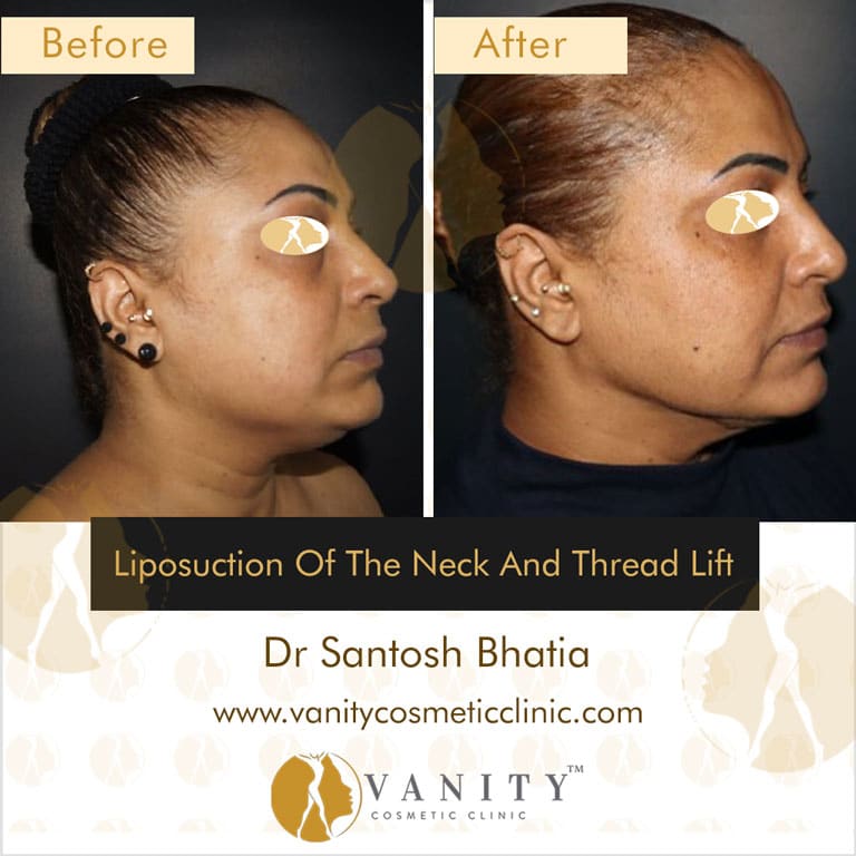 Liposuction-of-the-Neck-and-Thread-lift-right-side-view