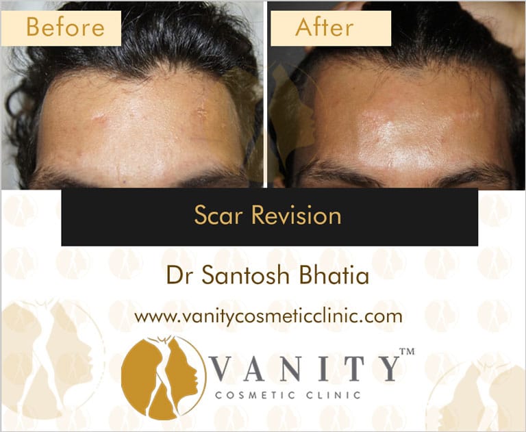 Scar-Revision-left-side-view-1