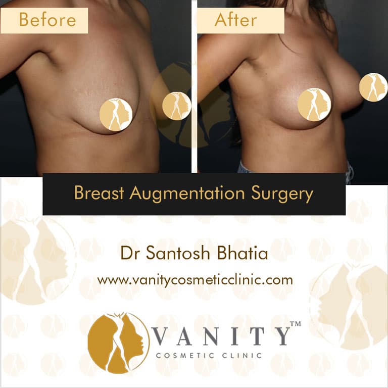 Case 1 : Breast Augmentation Surgery 45 Degree Left Side View