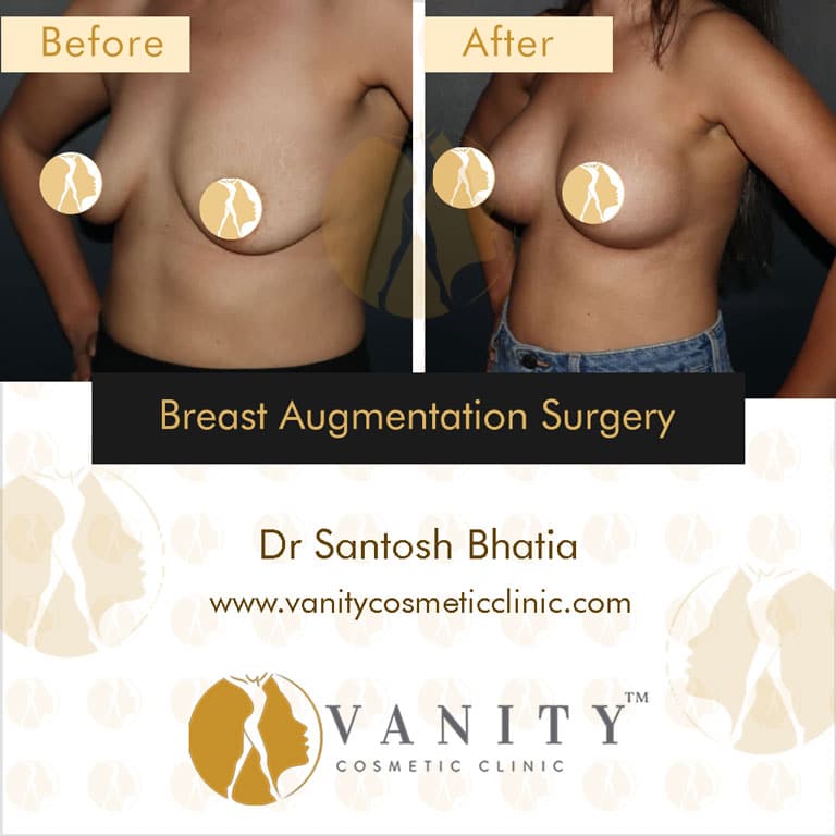 Case 1 : Breast Augmentation Surgery 45 Degree Right Side View