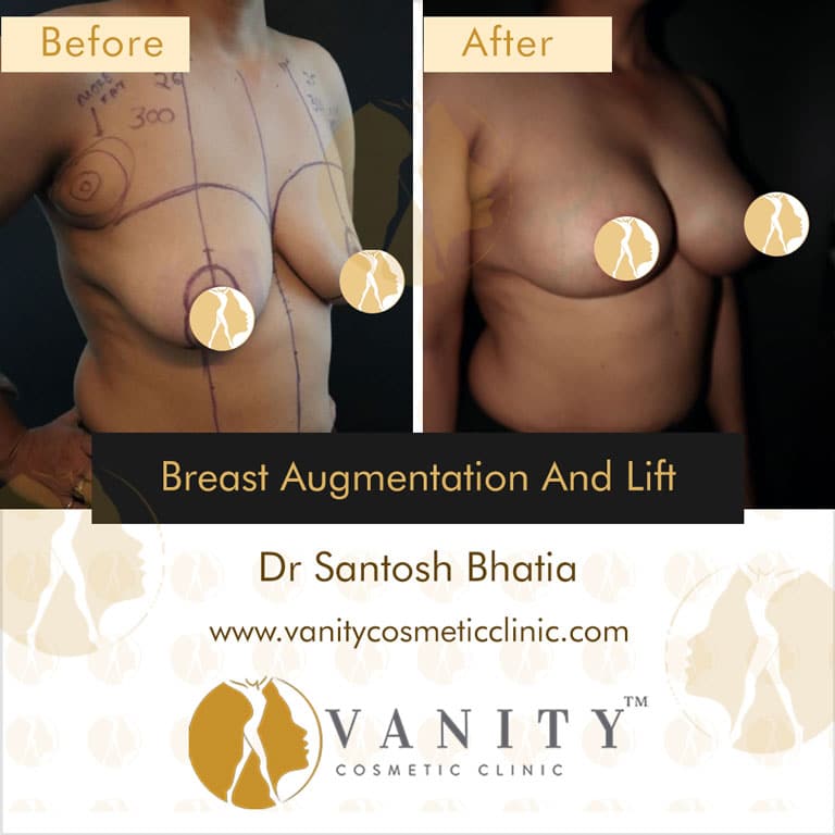 Case 4 : Breast Augmentation And Lift 45 Degree Left Side View