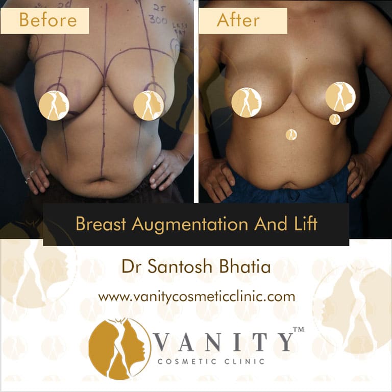 Case 4 : Breast Augmentation And Lift Front View