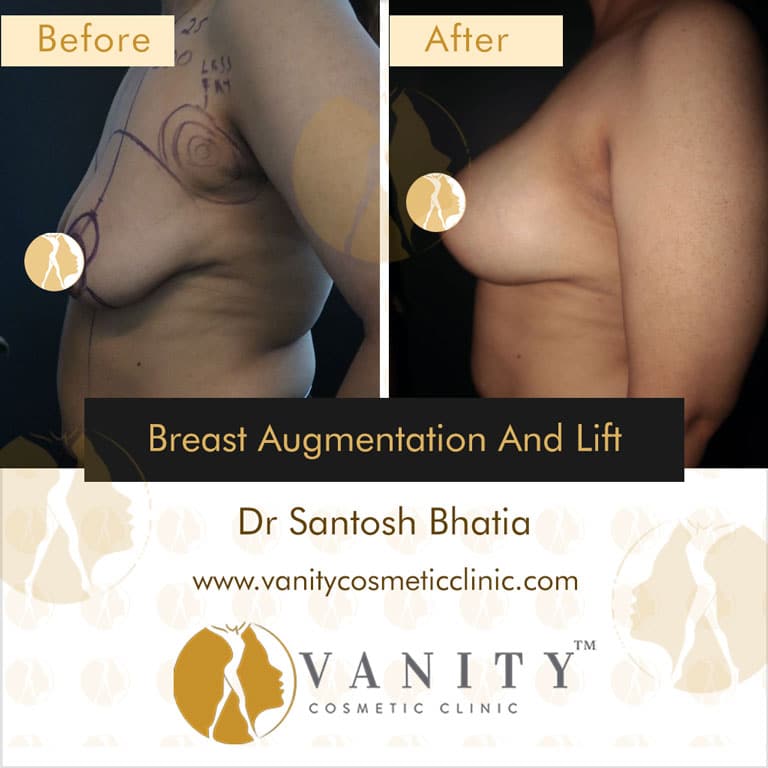 breast-augmentation-and-lift-right-side-view-case-5