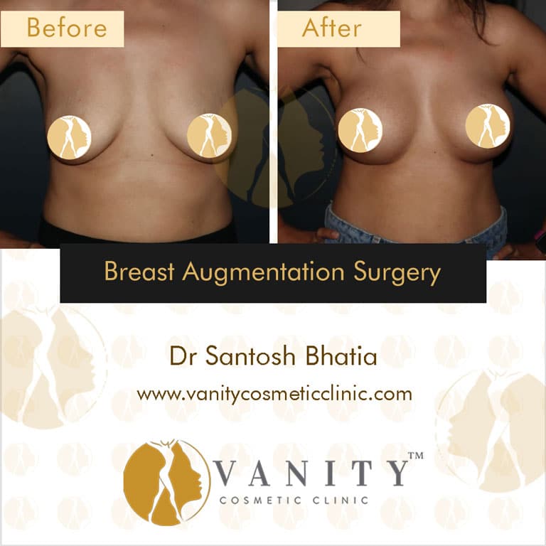 Case 1 : Breast Augmentation Surgery Front View