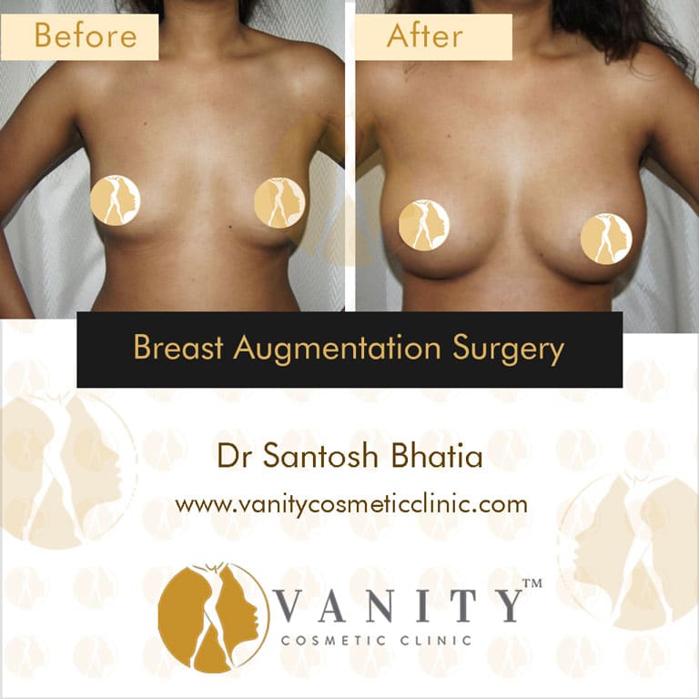 Case 3 : Breast Augmentation Surgery Front View
