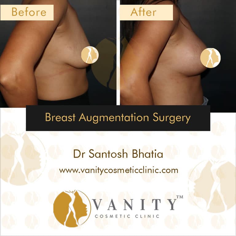 Case 1 : Breast Augmentation Surgery Left Side View