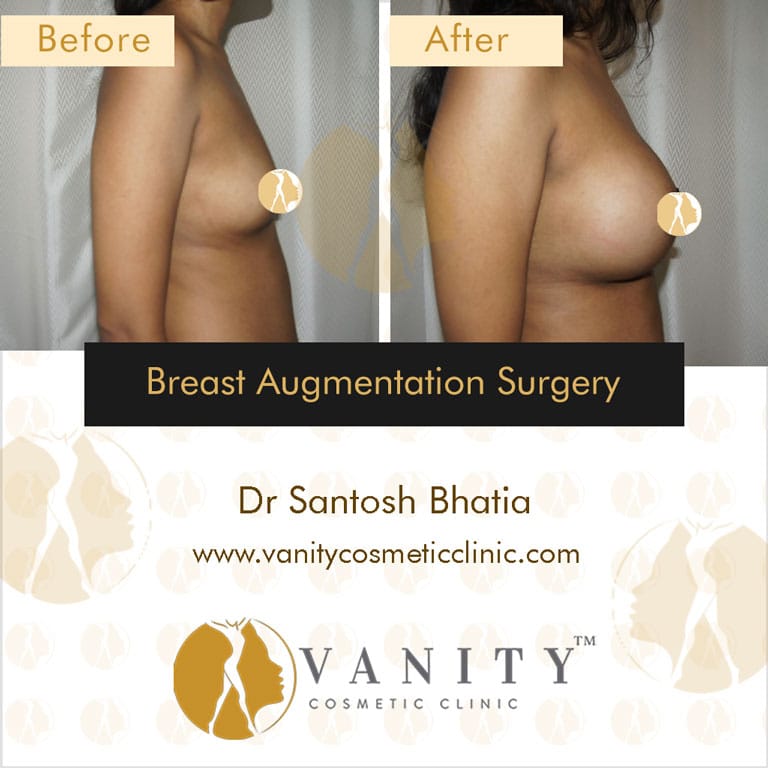 Case 3 : Breast Augmentation Surgery Left Side View