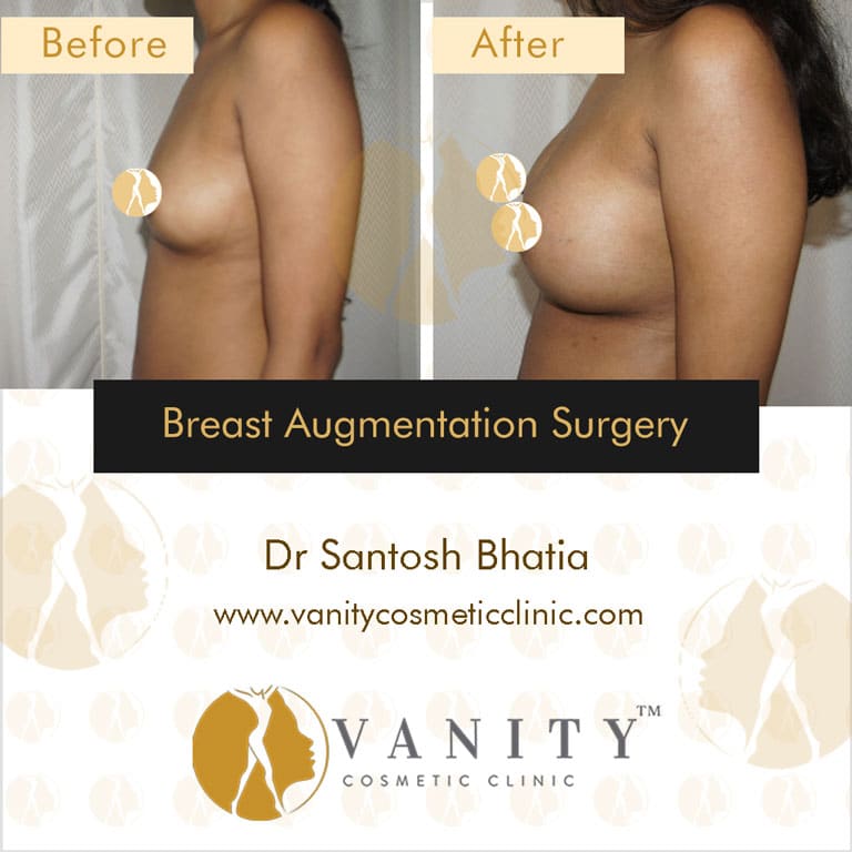 Case 3 : Breast Augmentation Surgery Right Side View