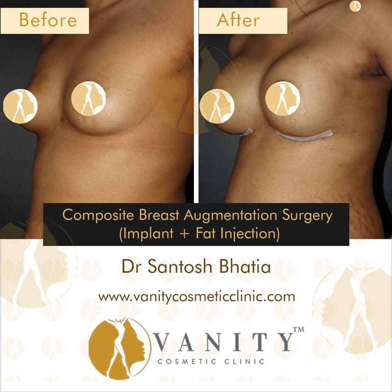 Case 6 : Breast Augmentation With Implants And Fat Injection 45 Degree Right Side View