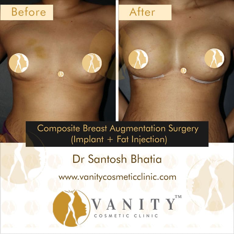 Case 6 : Breast Augmentation With Implants And Fat Injection Front View