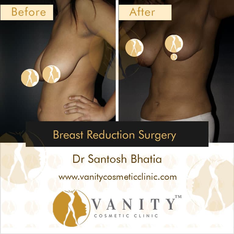 Case 1 : Breast Reduction Surgery 45 Degree Right Side View