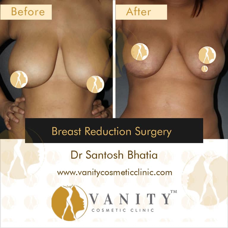 Case 1 : Breast Reduction Surgery Front View