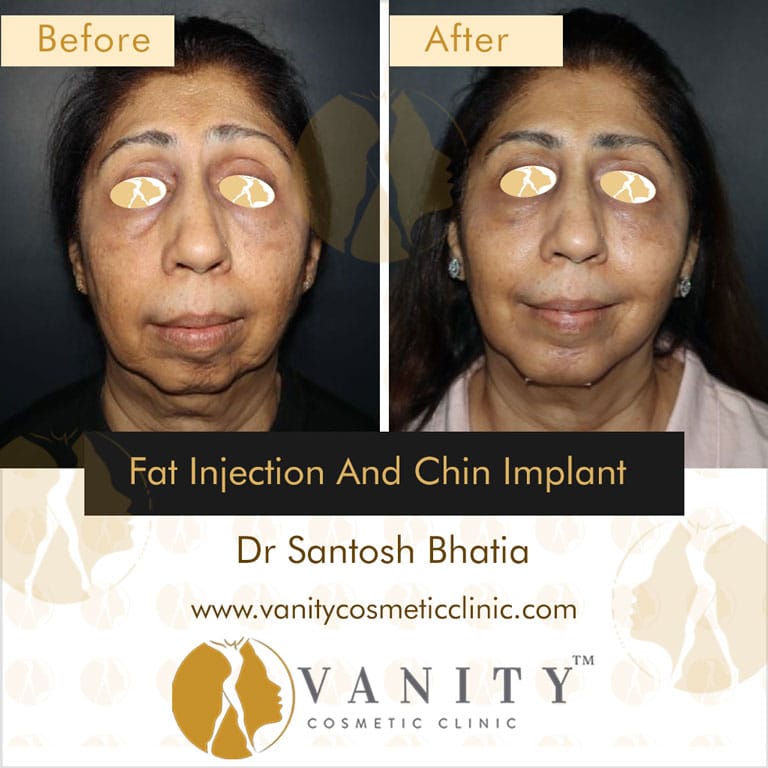 fat-injection-and-chin-implant-front-view