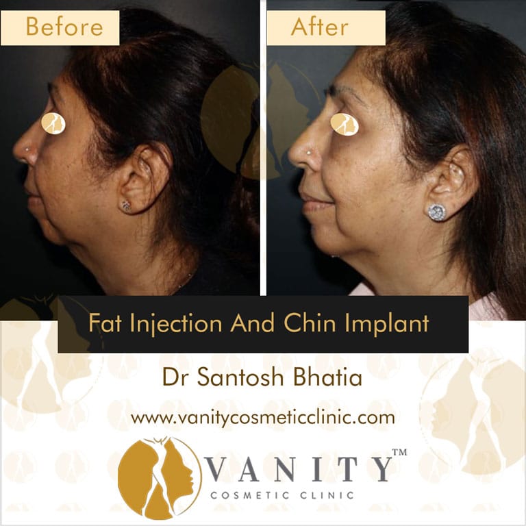 fat-injection-and-chin-implant-left-side-view