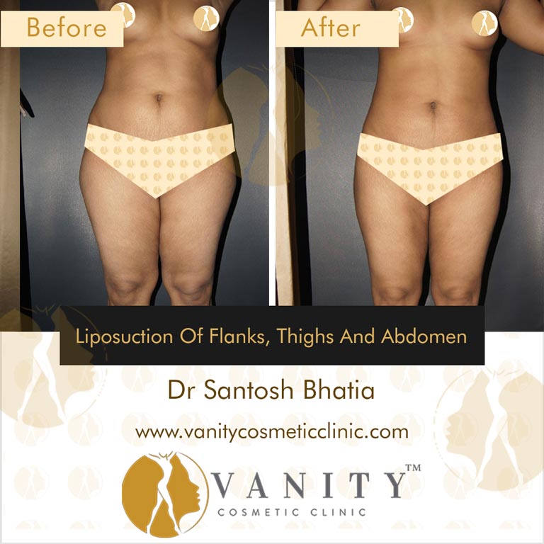 Liposuction of flanks, upper outer thigh, upper inner thigh, lower inner thigh and abdomen Front View