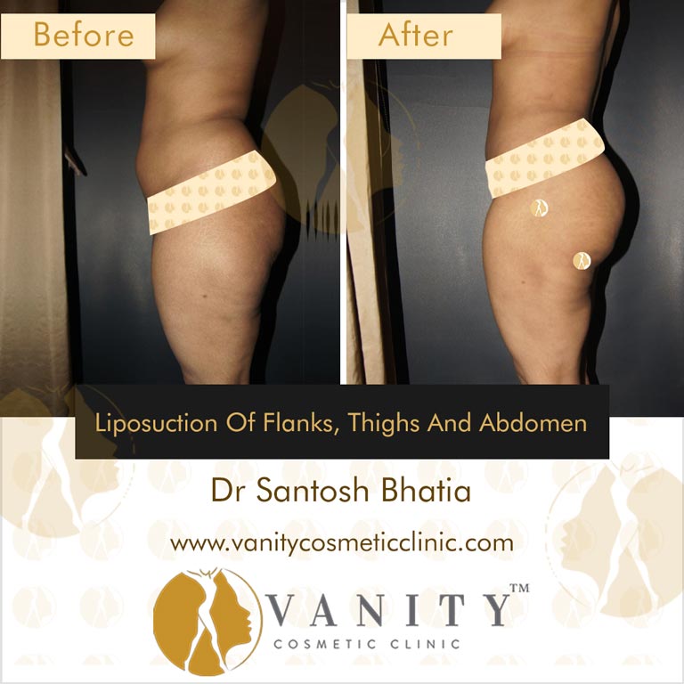 Liposuction of flanks, upper outer thigh, upper inner thigh, lower inner thigh and abdomen Side View