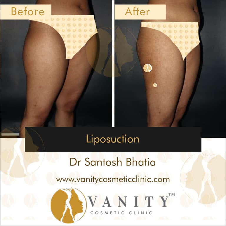 Liposuction 45 Degree Right Side View