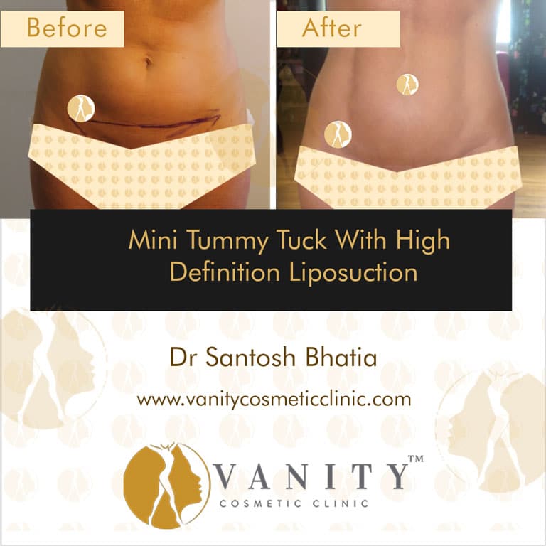 Mini Tummy Tuck with High Definition liposuction Front View