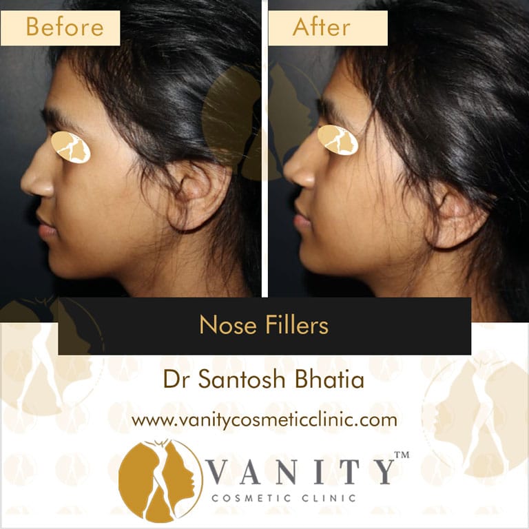 nose-fillers-left-view
