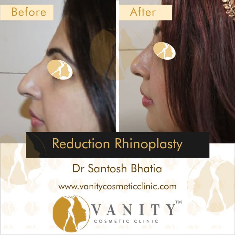 reduction-rhinoplasty-left-right-side-view-1