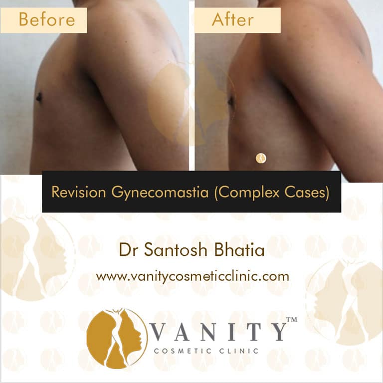 revision gynecomastia (complex cases)-left-side-view-case-2
