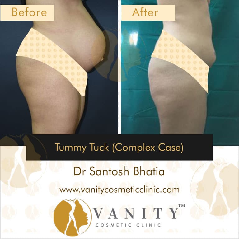 tummy-tuck-with-liposuction-comples-cases-right-side-view