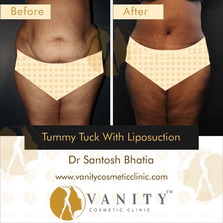 tummy-tuck-with-liposuction-front-view-1_11