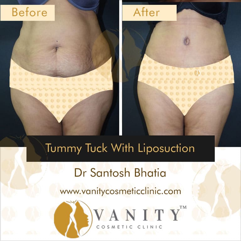 tummy-tuck-with-liposuction-front-view-2_1