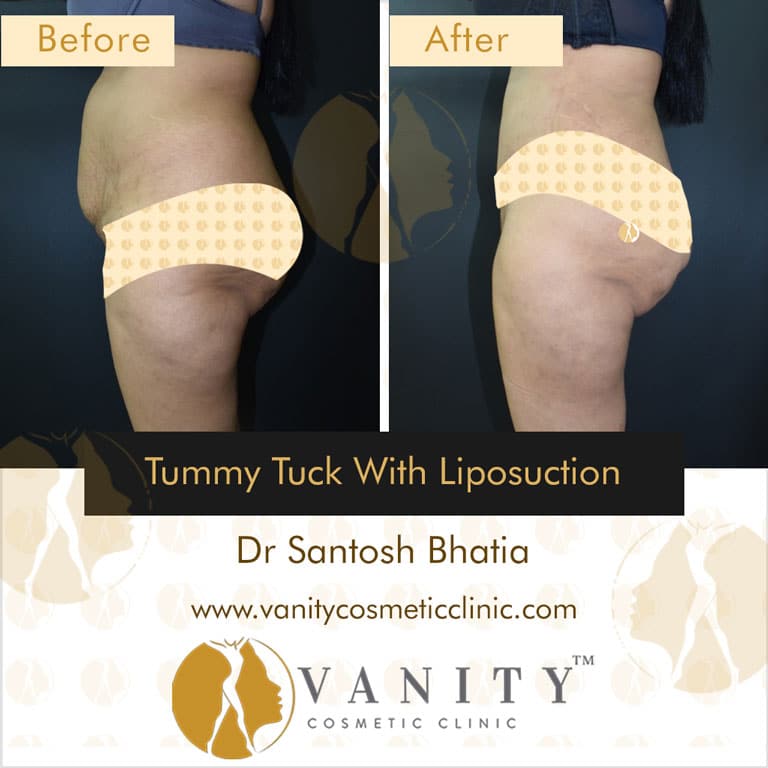 tummy-tuck-with-liposuction-left-side-view-2