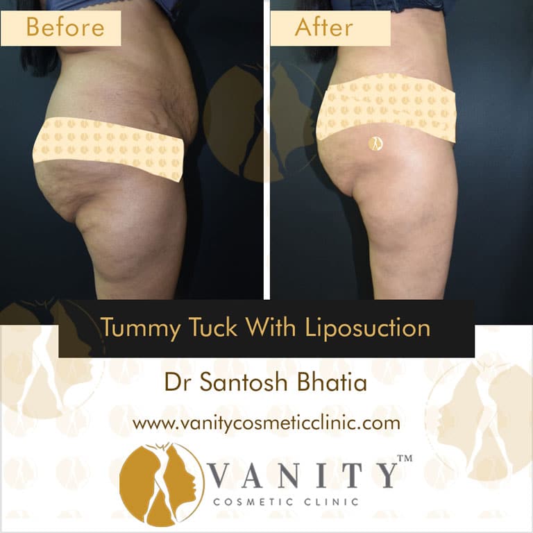 tummy-tuck-with-liposuction-right-side-view-2