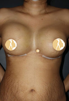 Composite Breast Augmentation (Implant+Fat Injection) After