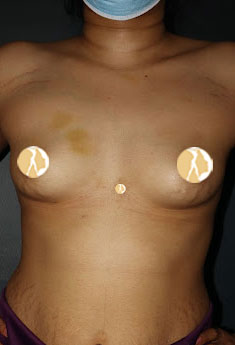 Composite Breast Augmentation (Implant+Fat Injection) Before