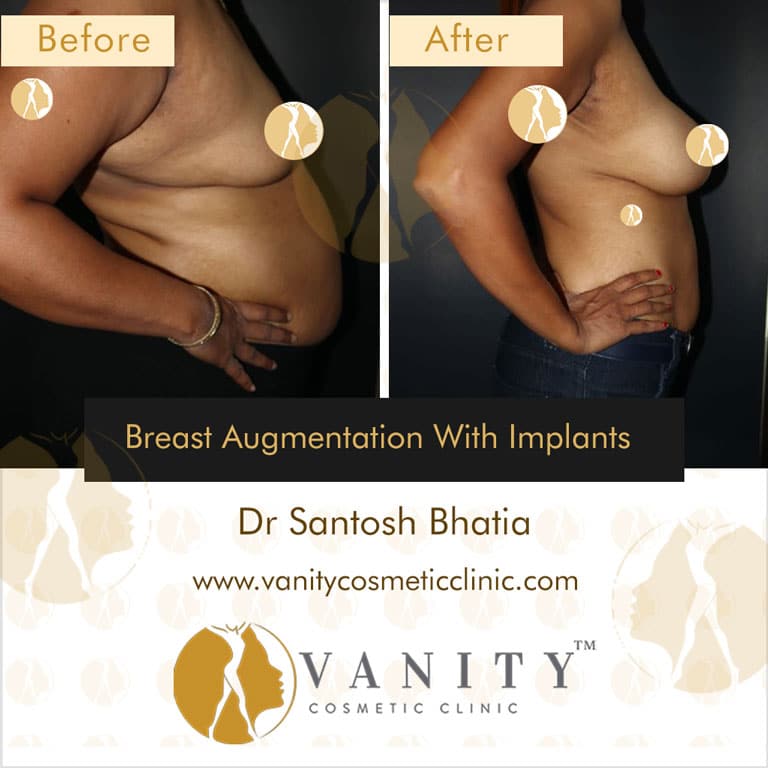 breast-augmentation-with-implants-right-view-case-6-1