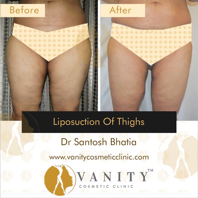 liposuction-thighs-front-view