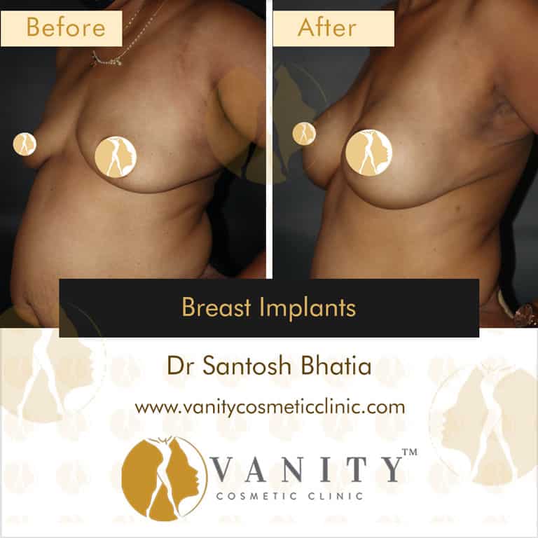 breast-implants-vanity-cosmetic-clinic-45-deg-left-side-view-case-1