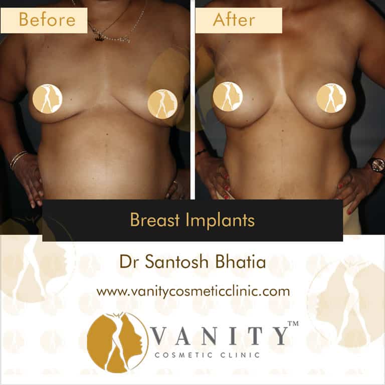 breast-implants-vanity-cosmetic-clinic-front-view-case-1