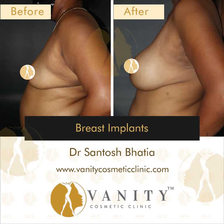 breast-implants-vanity-cosmetic-clinic-left-side-view-case-1